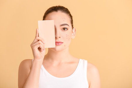 Young woman with acne problem and blank card on color backgroundの写真素材