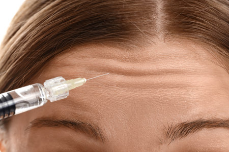 Young woman receiving filler injection in forehead, closeupの写真素材