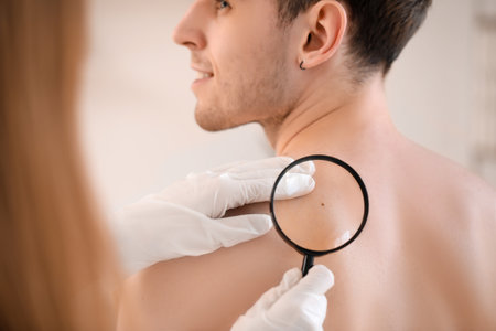 Dermatologist examining mole on young man's back with magnifier in clinic, closeupの写真素材