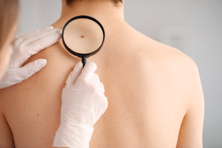 Dermatologist examining mole on young man's back with magnifier in clinic, closeupの写真素材