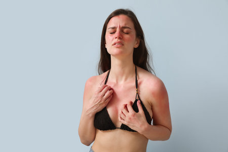 Allergic young woman with sunburned skin on blue background