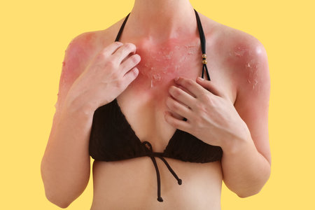 Allergic young woman with sunburned skin on yellow backgroundの写真素材