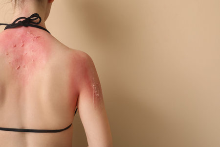Allergic young woman with sunburned skin on beige background, back viewの写真素材