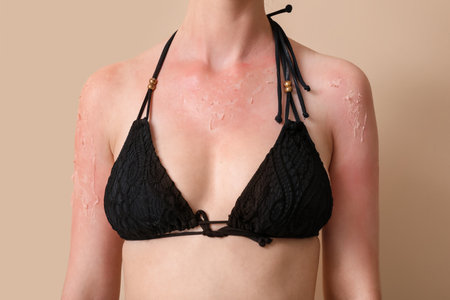 Allergic young woman with sunburned skin on beige background, closeupの写真素材