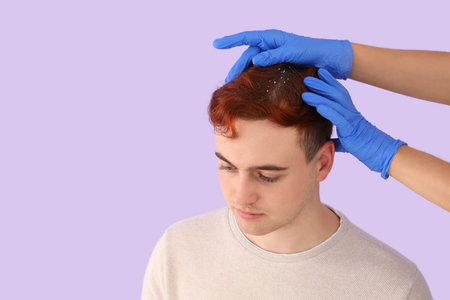 Trichologist examining young redhead man with problem of dandruff on lilac backgroundの写真素材