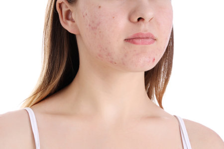 Teenage girl with acne problem on white background, closeupの写真素材