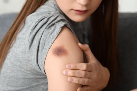 Young woman with bruise on her shoulder at home, closeupの写真素材