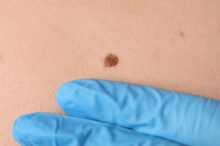 Dermatologist examining mole on woman's body, closeup