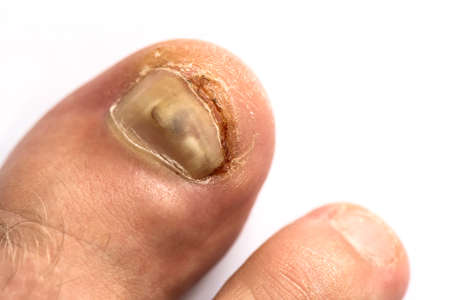 Hematoma under the nail, damaged big toe. Sore toe. Remains of blood on the skin near the nail.の写真素材