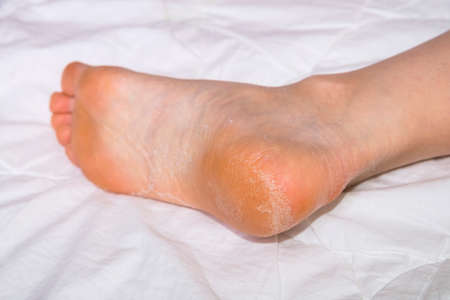 Womans feet with dry heel. Damaged skin. Heel with flaky skin on a white wrinkled sheet. Selective focus.の写真素材
