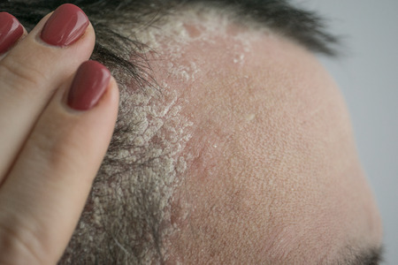 psoriasis on the hairline and on the scalp-close up, dermatological diseases, skin problems.の写真素材