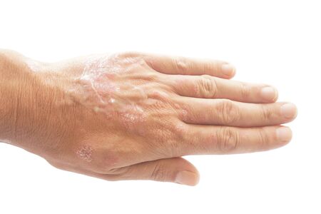 Psoriasis vulgaris and fungus on the man hand and fingers with plaque, rash and patches on the skin, isolated on white background. Autoimmune genetic disease. Clipping path insideの写真素材