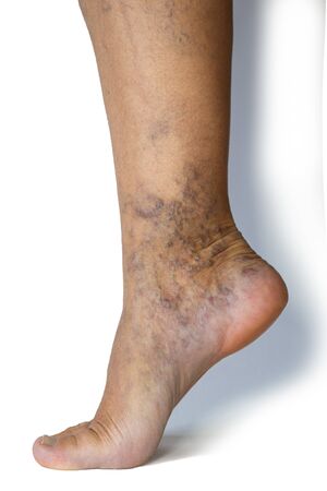 Varicose veins on a female legs. Phlebology problem. Woman's health.の写真素材