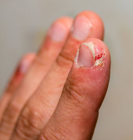 index finger dermatitis on male hand, closeup.の写真素材