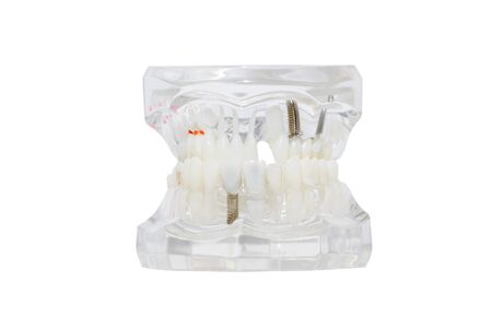 Dental implant in the gum. Isolated on white.