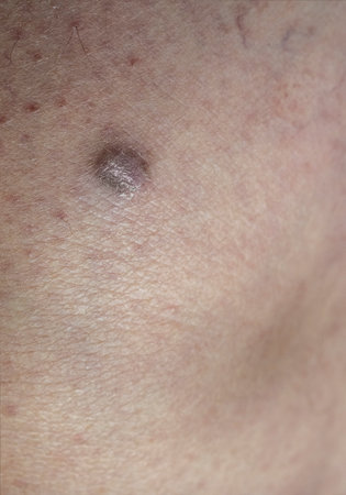 Close-up view of the an human skin with human skin sarcoma. Large suspicious dangerous mole on the skinの写真素材