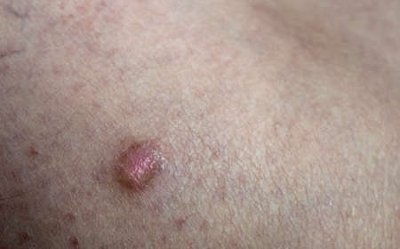 Close-up view of the an human skin with human skin sarcoma. Large suspicious dangerous mole on the...