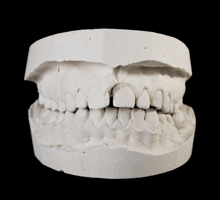 alabaster cast jaws man. Dental blank.