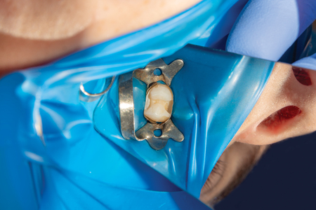 Treatment of caries of a human tooth close-up. The concept of dental restoration of the tooth with composite material.の写真素材