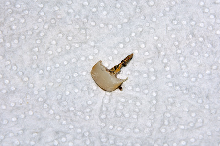 Treatment of the roots of the tooth. Sealing and cleaning a carious human tooth close-up of a macro....