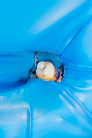 Dental caries. Filling with dental composite photopolymer material using rabbders. The concept of dental treatment in a dental clinicの写真素材