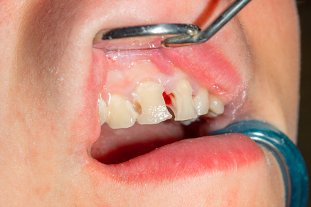two chewing side teeth of the upper jaw after treatment of caries. Restoration of the chewing...
