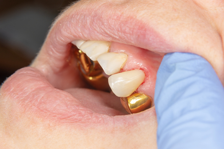 two chewing side teeth of the upper jaw after treatment of caries. Restoration of the chewing surface with a photopolymer filling material using the Rubber Dam systemの写真素材