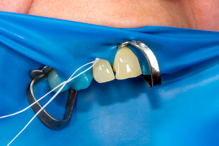 two chewing side teeth of the upper jaw after treatment of caries. Restoration of the chewing surface with a photopolymer filling material using the Rubber Dam systemの写真素材