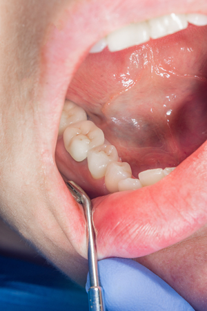 Dental crown metal ceramics close-up in the patient's mouth in the dental clinic. The concept of prosthetics with the use of implants and denturesの写真素材