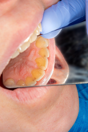 Dental caries. Filling with dental composite photopolymer material using rabbders. The concept of dental treatment in a dental clinicの写真素材