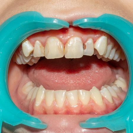 rotten teeth, caries and plaque close-up an asocially ill patient. The concept of poor hygiene and health problemsの写真素材