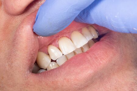 human tooth decay close-up at dentist's appointment. Poor oral hygiene, prevention