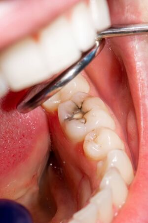 restoration of tooth with photopolymer filling close-up macro. Cariesの写真素材