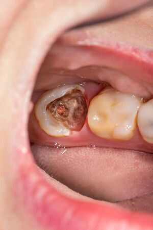 Dental caries. Filling with dental composite photopolymer material using Rubber Dam. The concept of dental treatment in a dental clinicの写真素材