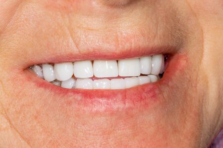 Plaque of the patient, stone. Dentistry treatment of dental plaque, professional oral hygiene. The concept of harm to smoking and cleaning teethの写真素材