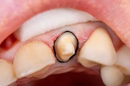 preparation of a human tooth for manufacture of crowns, dental impression. Close-up macroの写真素材