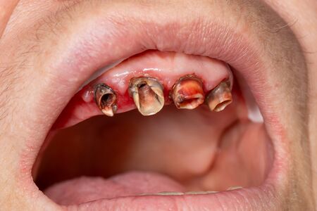 Dental crown metal ceramics close-up in the patient's mouth in the dental clinic. The concept of prosthetics with the use of implants and dentures, tooth impressionの写真素材