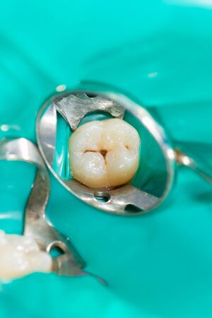 Dental caries. Filling with dental composite photopolymer material using rabbders. The concept of dental treatment in a dental clinicの写真素材