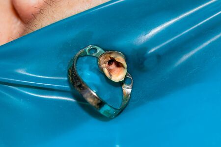 Treatment of the roots of the tooth. Sealing and cleaning a carious human tooth close-up of a macro....