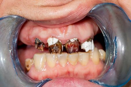 Plaque of the patient, stone. Dentistry treatment of dental plaque, professional oral hygiene. The concept of harm to smoking and cleaning teethの写真素材