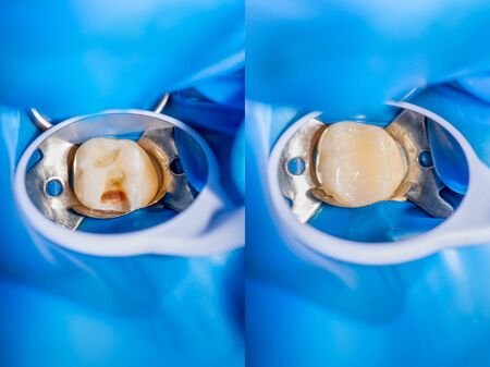 Dental caries. Filling with dental composite photopolymer material using rabbders. The concept of...