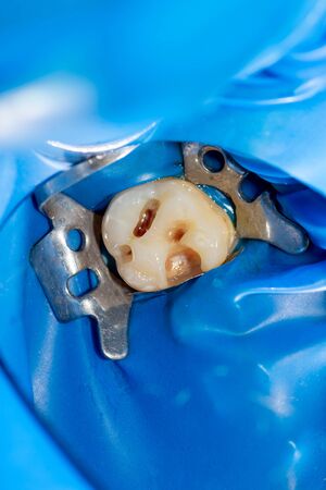 close-up treatment of a human tooth using blue rabberdam system and a dental mirror. Aesthetic dentistry, hygieneの写真素材