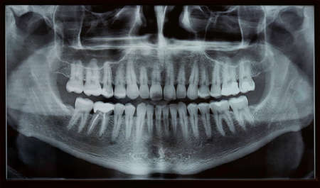 Detail of a panoramic dental radiograph, X-ray plate seen on a monitorの写真素材
