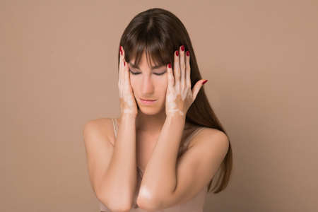 A young pretty long-haired woman with skin pigmentation suffering from a headacheの写真素材