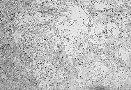 Glioblastoma cell culture. Human malignant astrocytoma cells under a microscope.