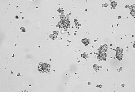 Spheroids of glioblastoma cell culture. Spheroidal structures of human malignant brain tumor cells...