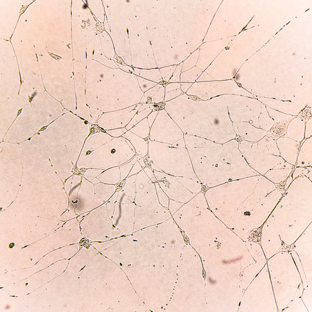 Human glioma cells. Human brainstem glioma cell culture under a microscope.の写真素材