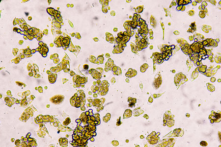 Melanoma metastasis cells in the human brain. Metastasis cell culture under a microscope.