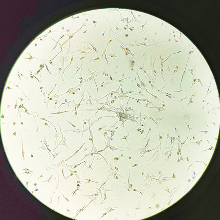 Glioblastoma cell culture. Human glioma cells under magnification.