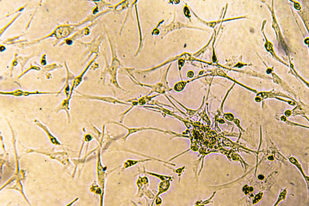 Glioblastoma cell culture. Human glioma cells under magnification.
